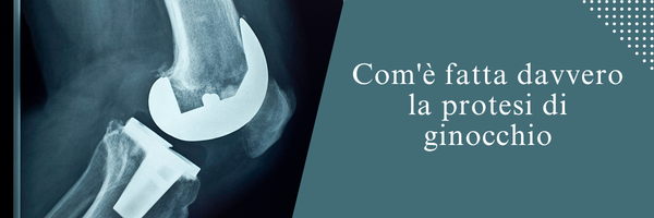 Com’è fatta davvero la protesi di ginocchio: